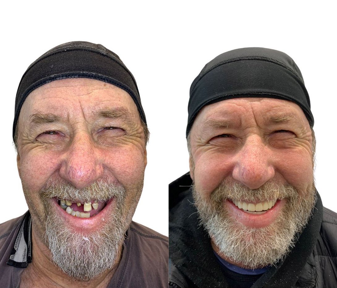 Full Arch Restoration — patient Geoff