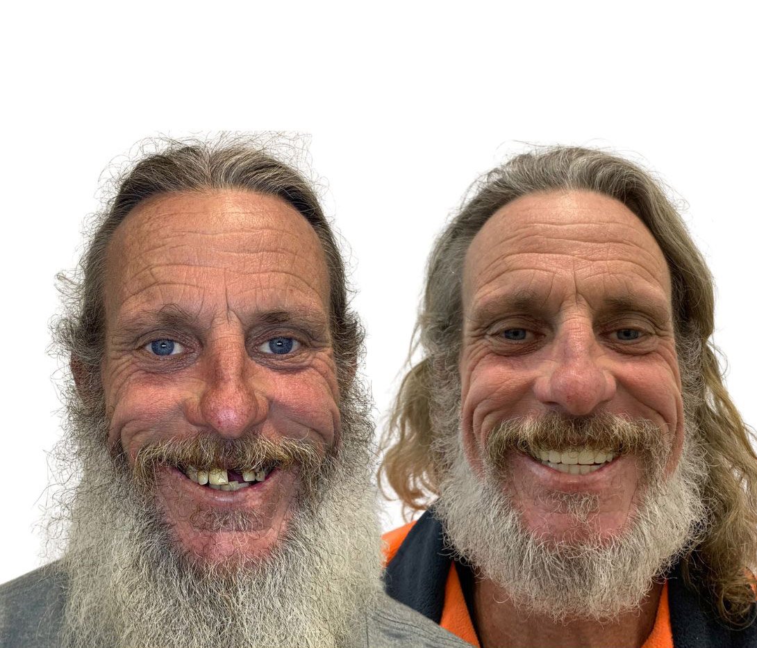 Full Arch Restoration — patient Heath
