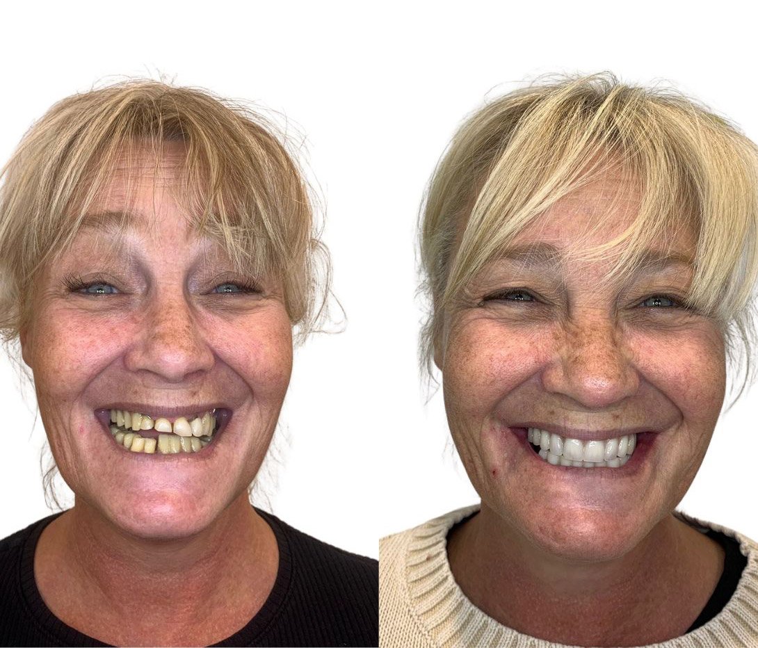 Full Arch Restoration — patient Sharon