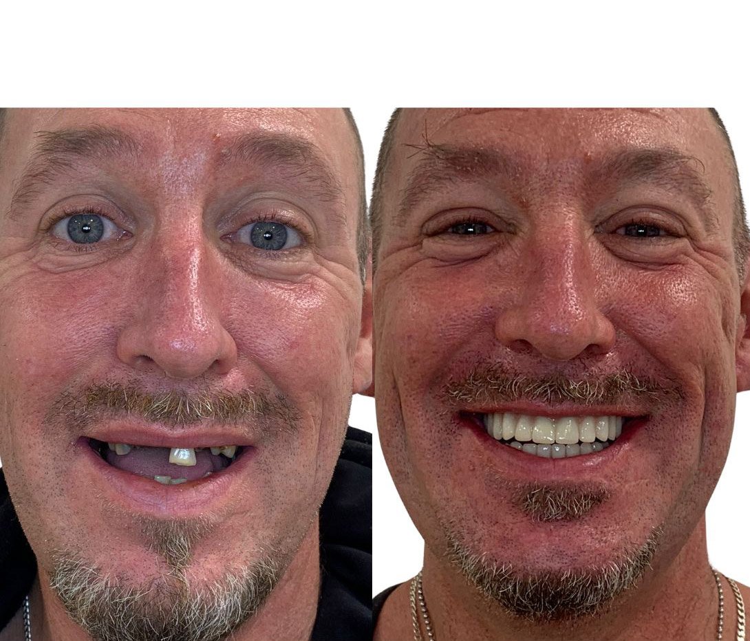 Full Arch Restoration — patient Stephen