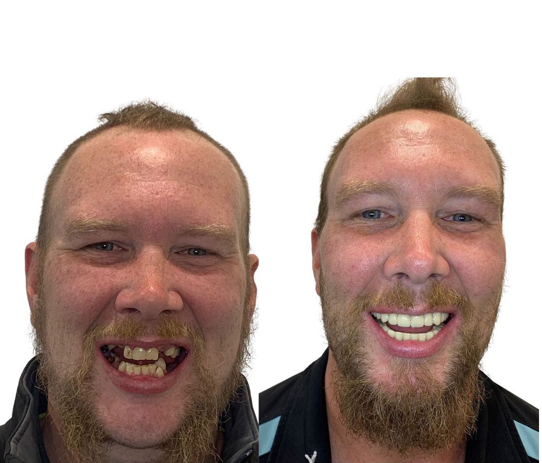 Full Arch Restoration — patient Damon