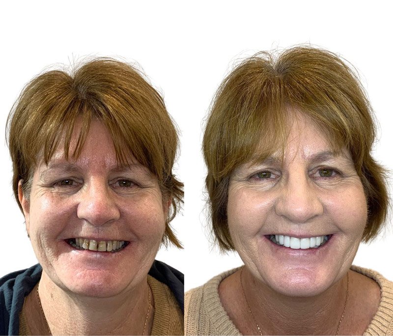 Crowns, Bridge & Veneers — patient Lisa